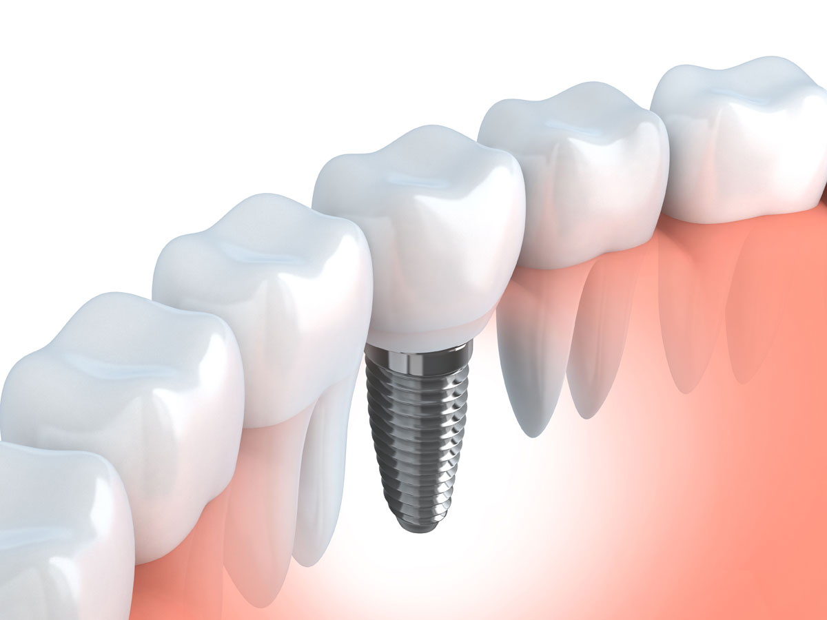 implante dental